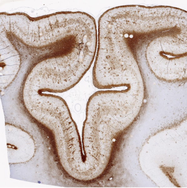 Impacts of TBI