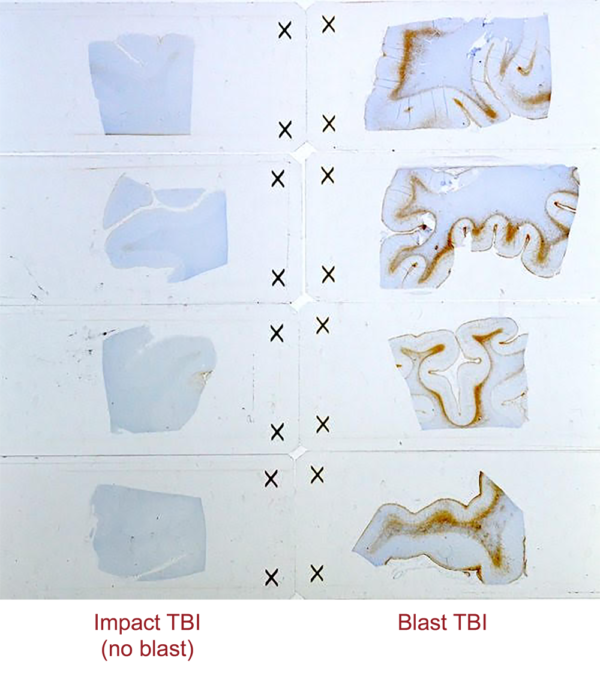 Image comparing Impact TBI to Blast TBI